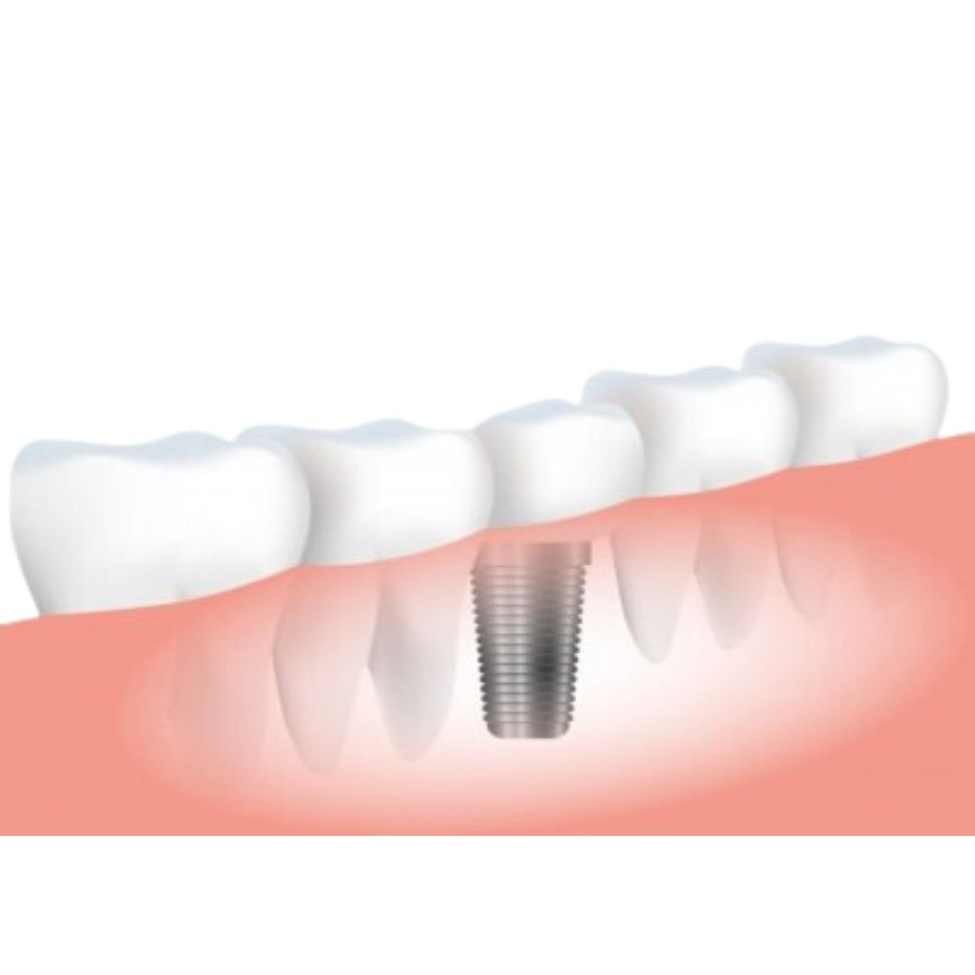 Dental Implants All Medical Devices Manufacturers Medzell Page 1